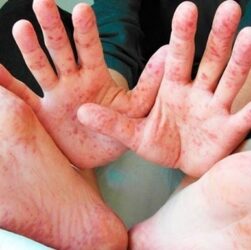 Новини Києва - У Києві фіксують спалах кору та гепатиту А