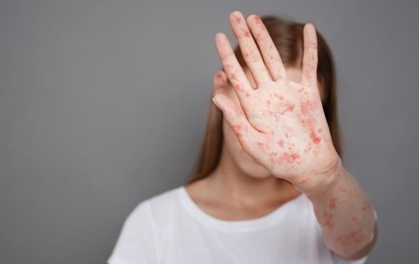 Новини України - В Україні зросла захворюваність на кір в 11 разів