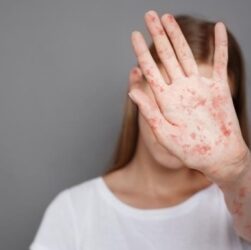 Новини України - Захворюваність на кір в Україні зросла удесятеро