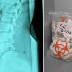 Новини світу - В Італії затримано жінку з 1,4 кг героїну в шлунку